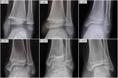 Value of growth arrest lines for predicting treatment effect on children with distal tibial epiphysis fractures